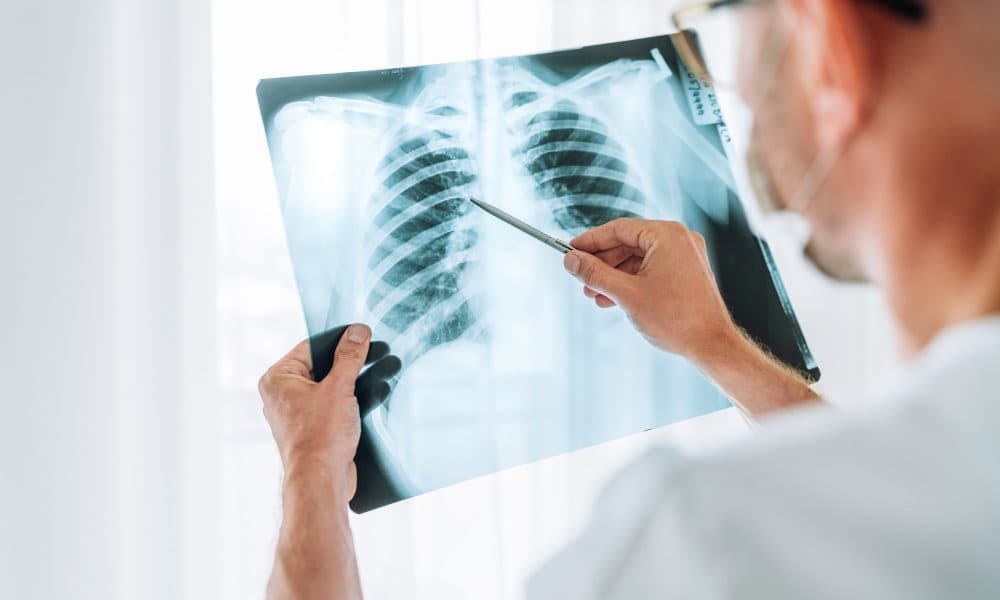Radiologists outperform AI in identifying lung diseases on chest X-ray